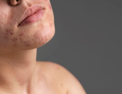 Acne: Causas, Tratamentos e Como Cuidar da Sua Pele