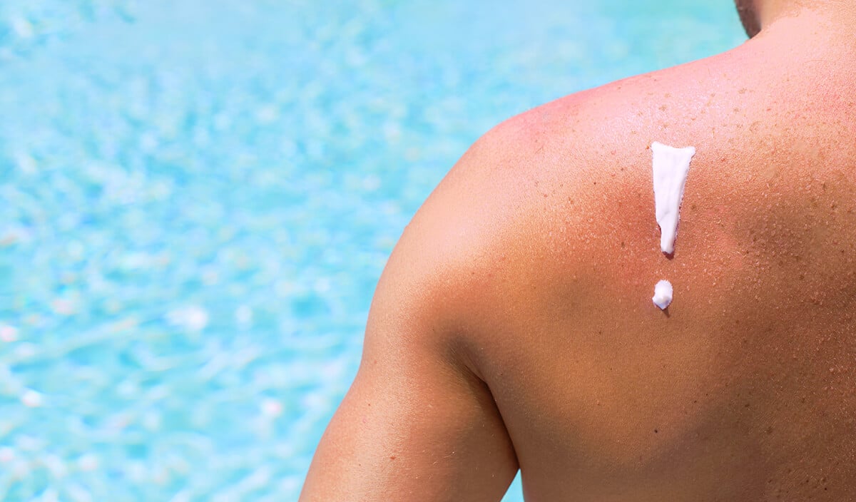 6 malefícios do sol na pele (além do câncer de pele)