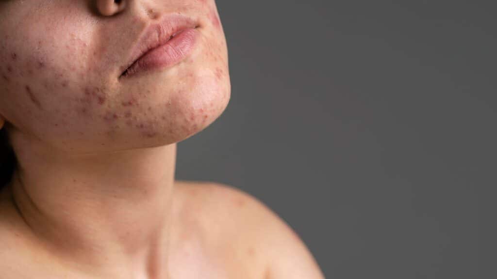 Tratamento para acne